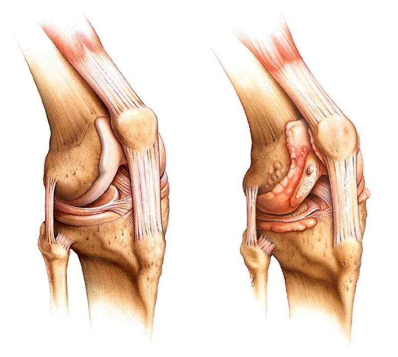 Vesela locītava (pa kreisi) un artrītiska locītava (pa labi)