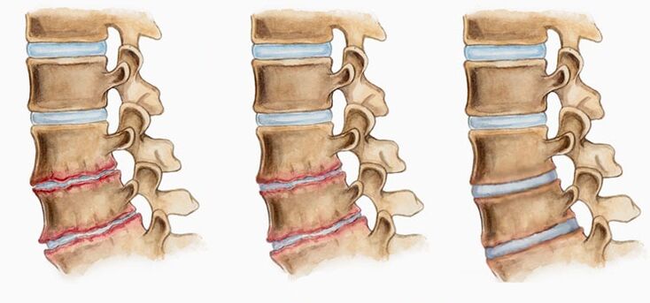 Osteohondrozes starpskriemeļu disku deformācija var izraisīt muguras sāpes