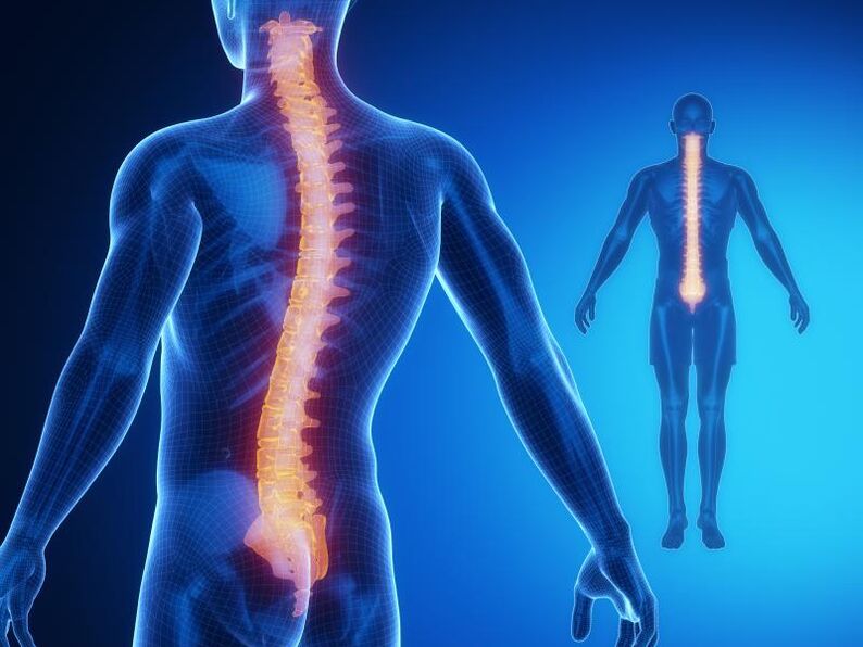 Mugurkaula osteohondroze, kurai nepieciešama sarežģīta ārstēšana